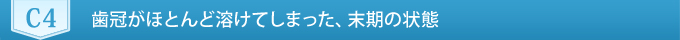 C4　歯冠がほとんど溶けてしまった、末期の状態