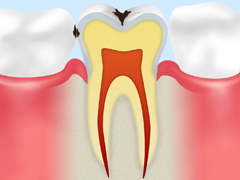 C1　痛みはなくても、徐々に進行中の虫歯