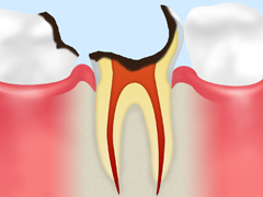 C4　歯冠がほとんど溶けてしまった、末期の状態