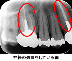 神経の処置をしている歯