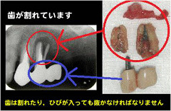 歯は生きている木と一緒