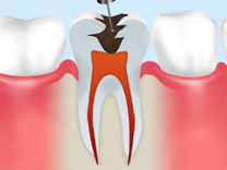 「ファイル」や「リーマー」などの專門器具を使用し、虫歯菌に冒された神経や血管を取り除きます。