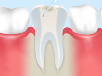 根管の内部をマイクロスコープや内視鏡で確認しながら、徹底的に洗浄・殺菌します。