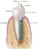 天然歯のようにしっかり噛みたい方にはインプラント