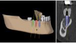 3D インプラント計画