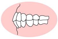 上下顎前突（じょうげがくぜんとつ）