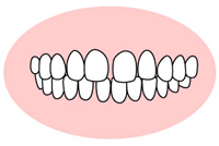 空隙歯列・正中離解（くうげきしれつ・せいちゅうりかい）