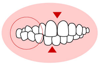 交叉咬合（こうさこうごう）
