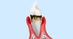 あなたのその症状、もしかして歯周病かもしれません